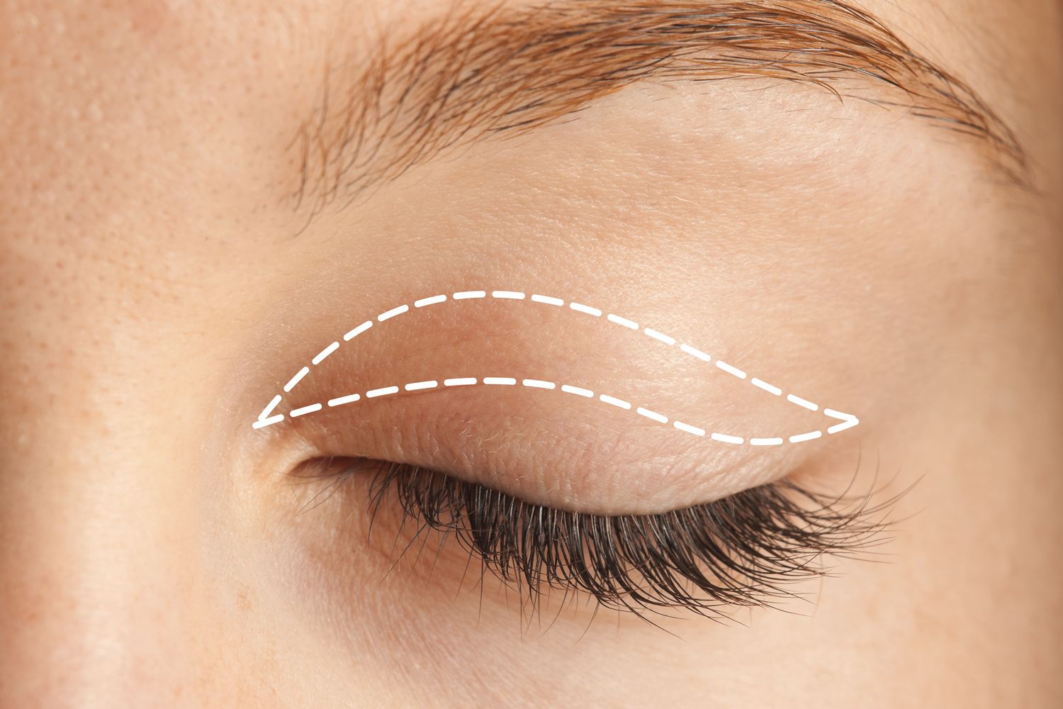 Photo of an eye with blepharoplasty line drawn on