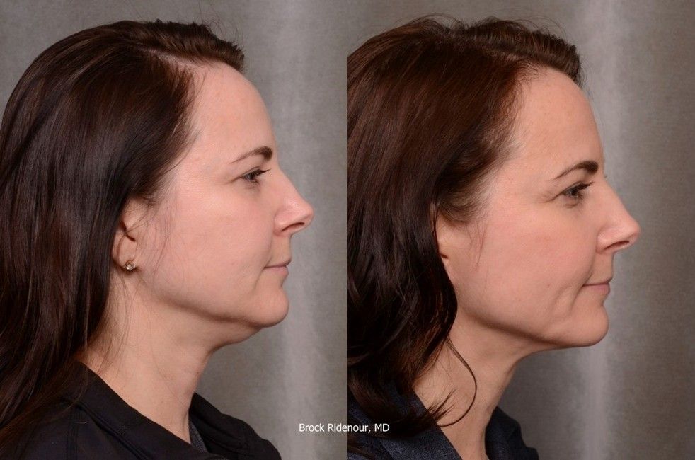 Before and after ThermiTight photos