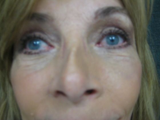 After eyelid surgery